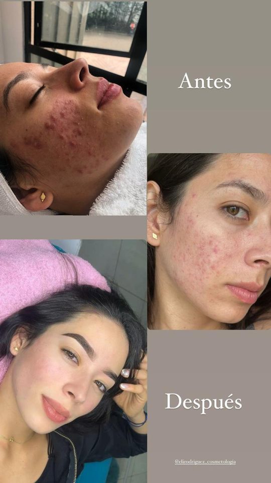 Piel con acné antes y después de las limpiezas faciales